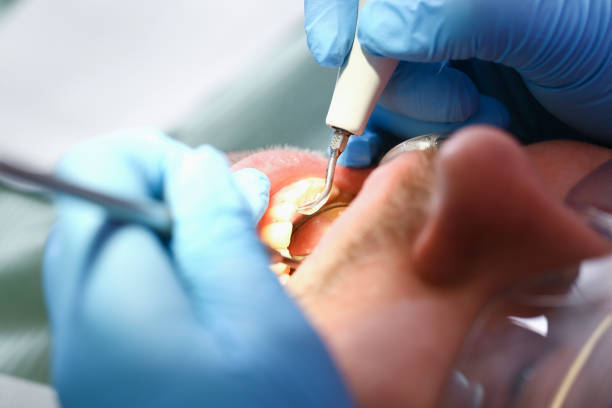 Best Emergency Dental Care for Broken or Chipped Teeth in Mountainside, NJ